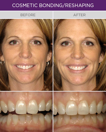 Artisan Family Dentistry - Cosmetic Bonding or Reshaping