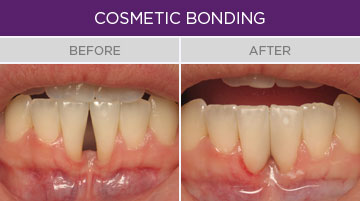 Artisan Family Dentistry - Cosmetic Bonding